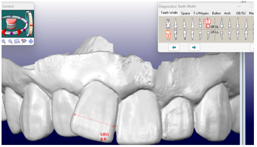 OrthoCAD 歯の計測10