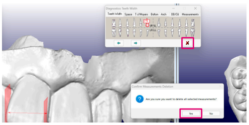 OrthoCAD 歯の計測11