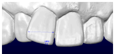 OrthoCAD 歯の計測12
