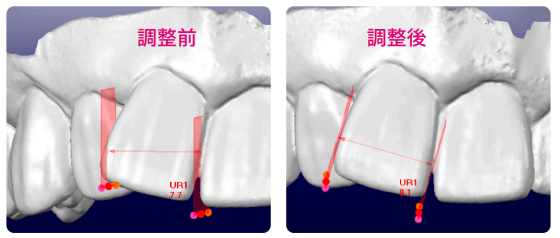 OrthoCAD 歯の計測13