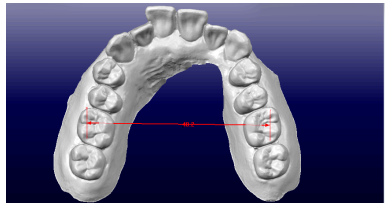 OrthoCAD 歯の計測16